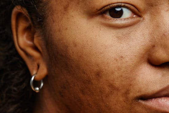 Pigmentpletter: Ekspertens råd til en sund og jævn hudtone