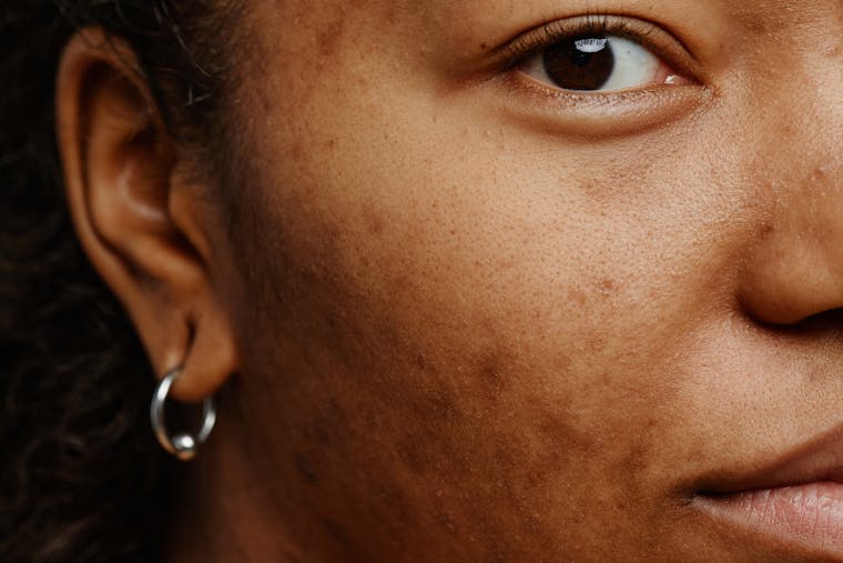 Pigmentvlekken: het advies van de expert voor een gezonde en egale teint