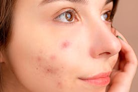 Onzuivere huid: Hoe onzuivere huid en acne effectief te behandelen