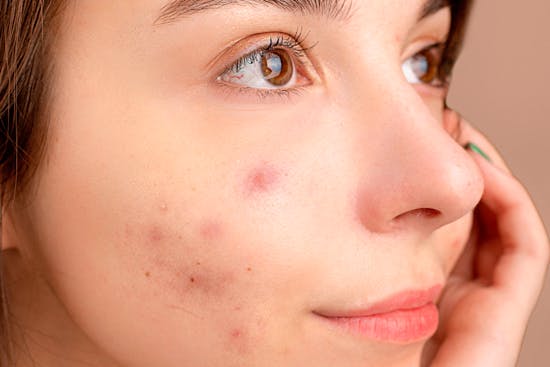 Onzuivere huid: Hoe onzuivere huid en acne effectief te behandelen