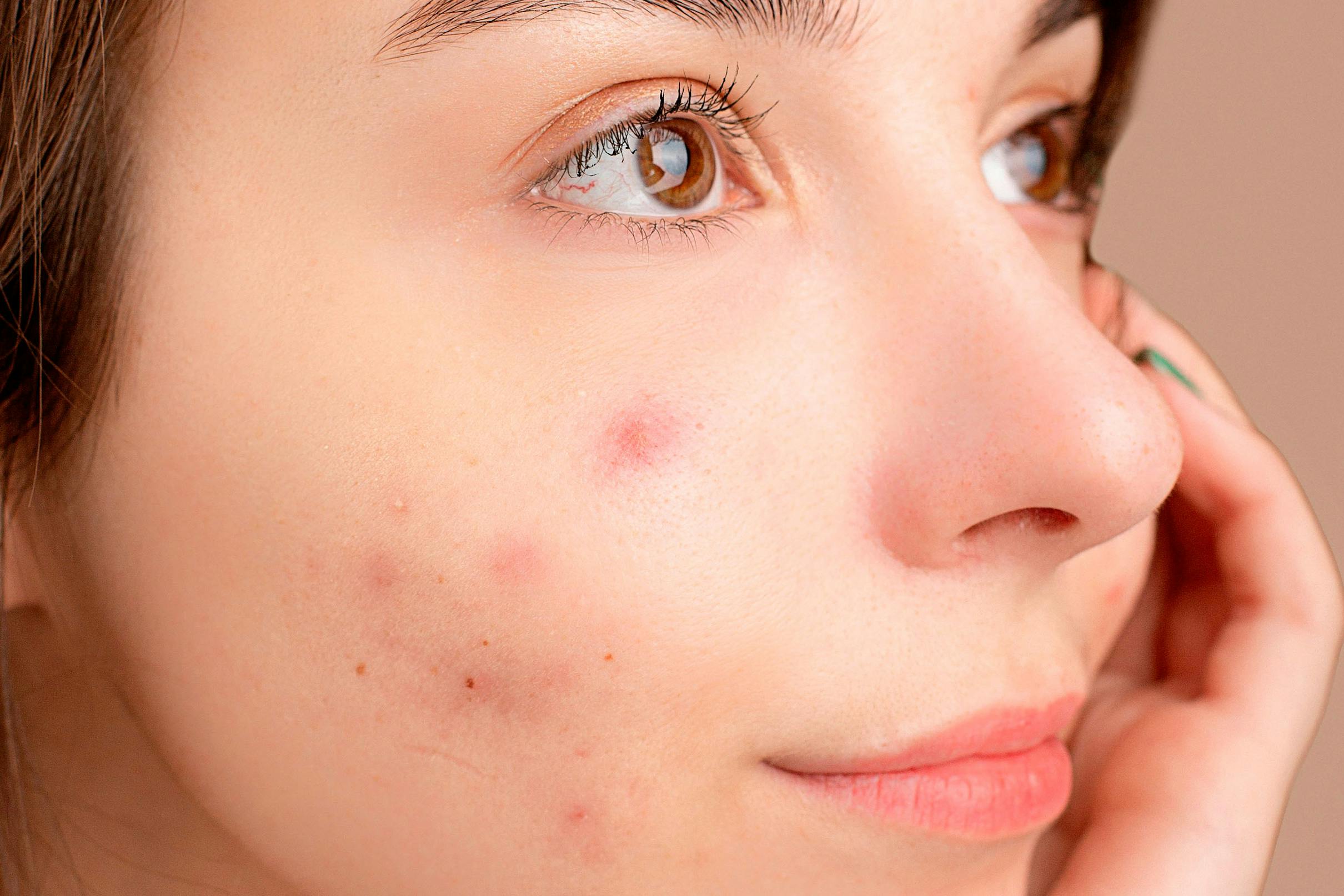 Onzuivere huid: Hoe onzuivere huid en acne effectief te behandelen