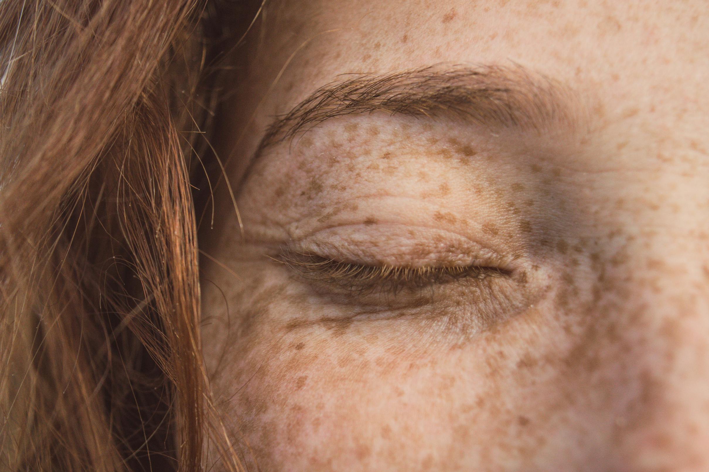 Gevoelige huid: Hoe te verzorgen