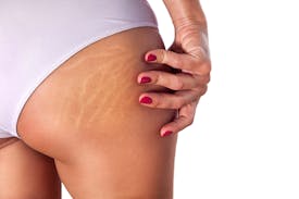 Striae: hoe je er op een natuurlijke en effectieve manier mee omgaat